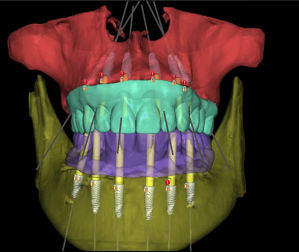 Colour-segmented maxillary anatomy with planned implant trajectories.