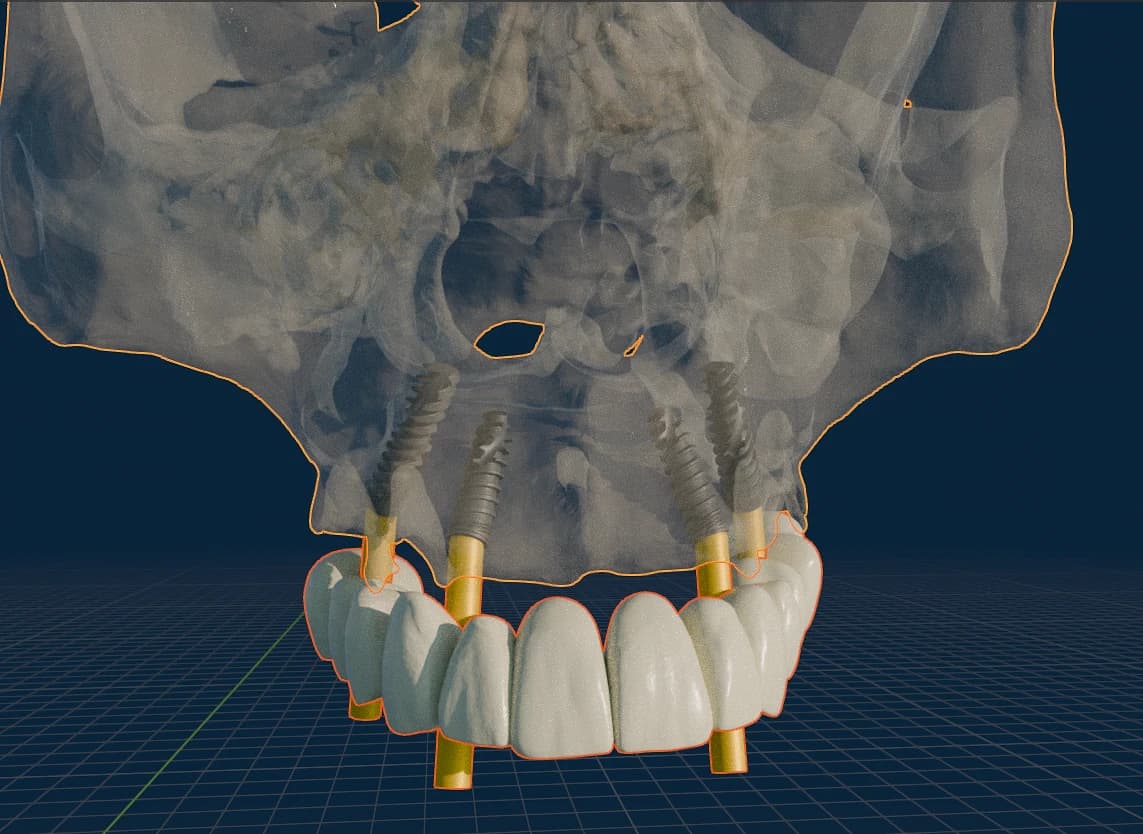 Restoration-led implant plan aligning tooth setup with implant positions.