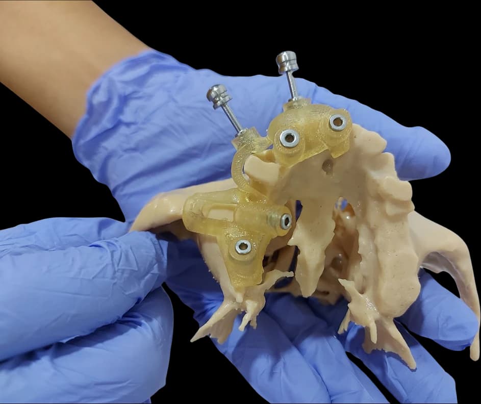 3D-printed zygomatic anatomy model with surgical guides, held in gloved hands.