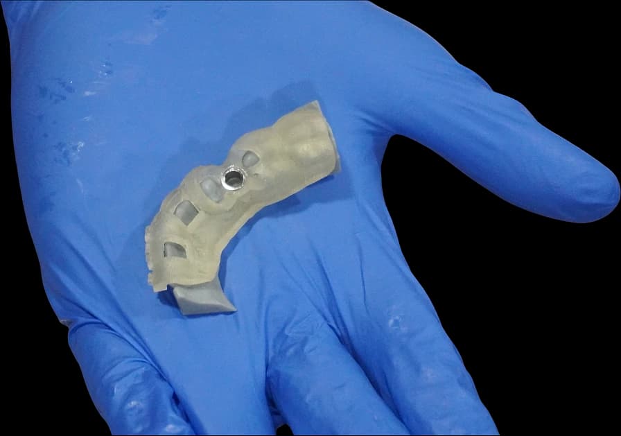 3D-printed surgical guide held in a gloved hand.