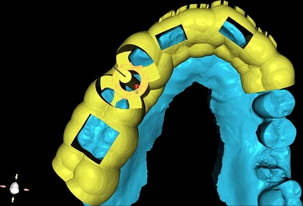 Single-implant surgical guide over a colour-mapped intraoral scan model.
