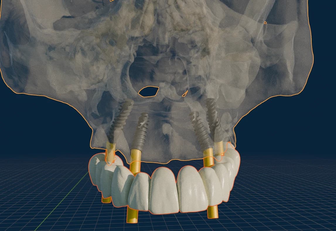 Anterior 3D implant plan with restoration reference over CBCT anatomy.