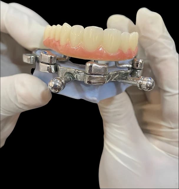 Full-arch implant prosthesis on a bar framework, held in a gloved hand.