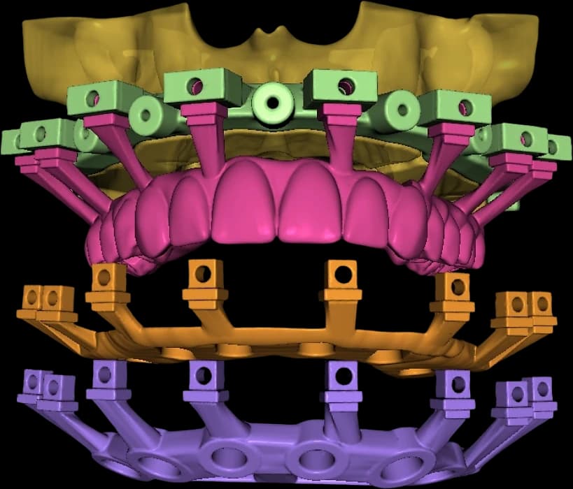 Exploded view of a prosthetic-driven full-arch stackable guide system, showing the stacked guide layers, connectors and prosthetic set.