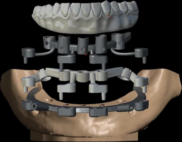 Full-arch stackable guide and metal framework seated on an anatomical model.