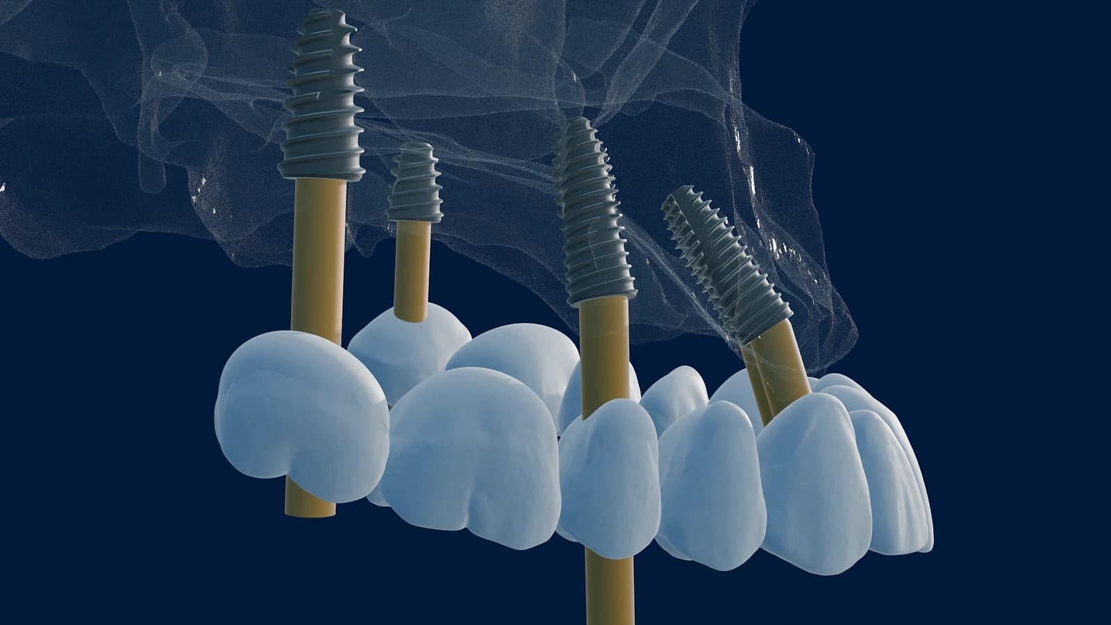 Digital implant plan: dental implants and gold abutments supporting a full-arch prosthesis over translucent jaw anatomy.