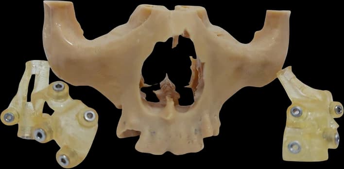 3D-printed anatomical bone models produced alongside a zygomatic guide.