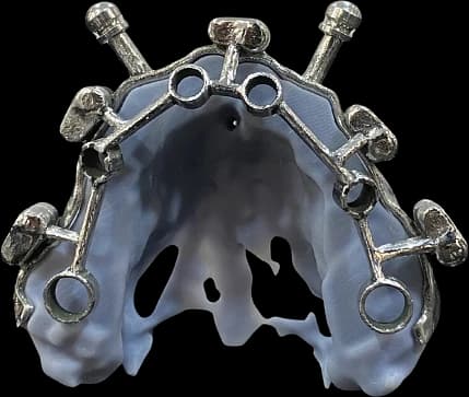Metal-reinforced full-arch surgical guide with stabilisation pins.