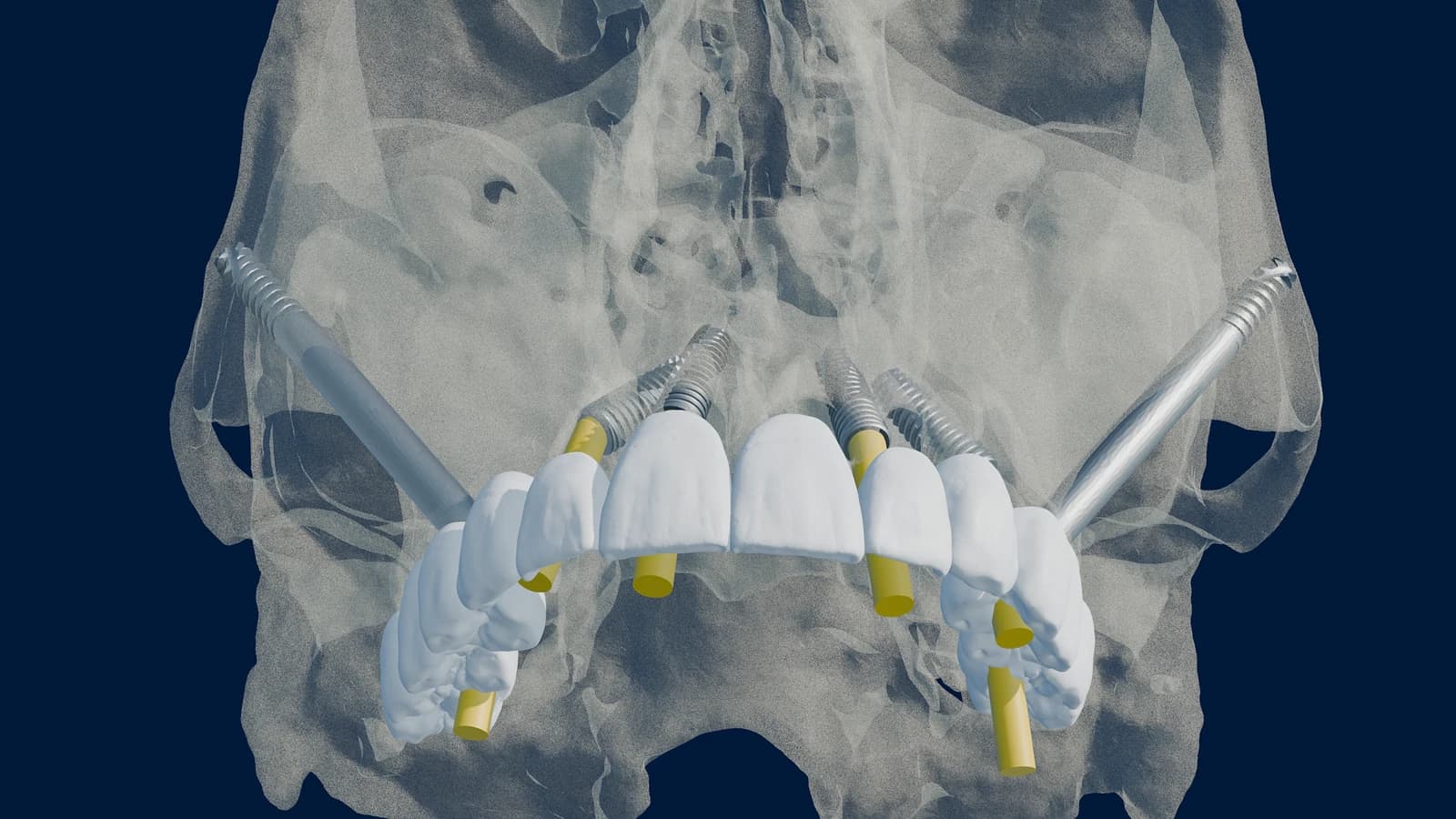 Zygomatic implant plan: four zygomatic implants engaging the zygomatic buttress with a full-arch prosthesis, shown over translucent skull anatomy.