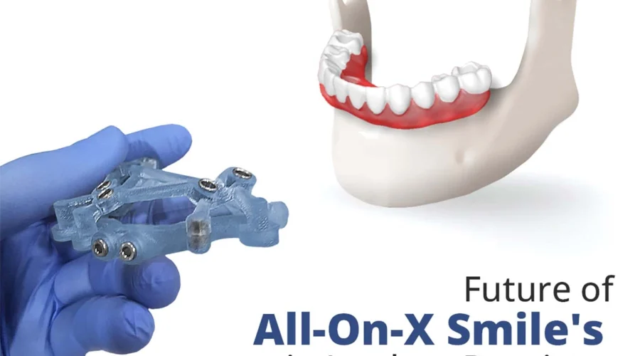 all-on-x-dental