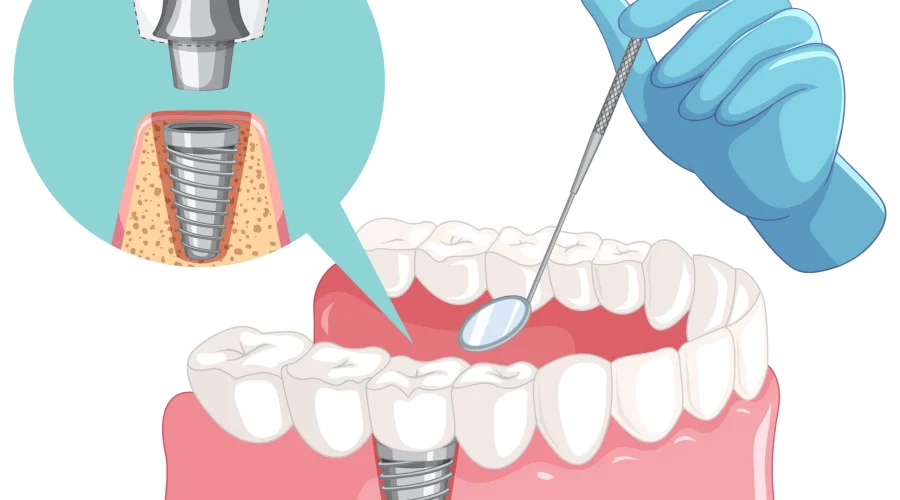 dental-implant-outcomes